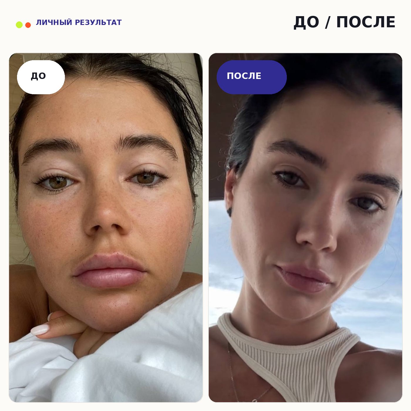 ЧЕЛЮСТЬ. Опоры лица - 3